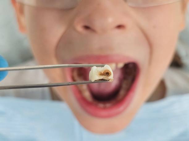 Best Emergency Dental Care for Abscessed Tooth in Bidwell, OH